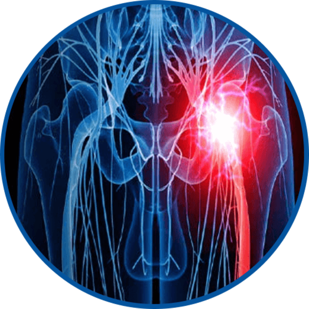 <h3><strong>Sciatica</strong></h3>