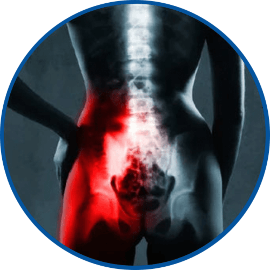 <h3><strong>SI Joint Dysfunction</strong></h3>